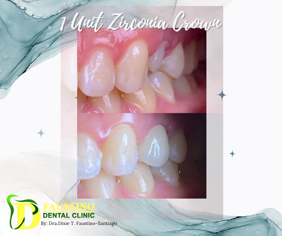 1 Unit Zirconia Crown