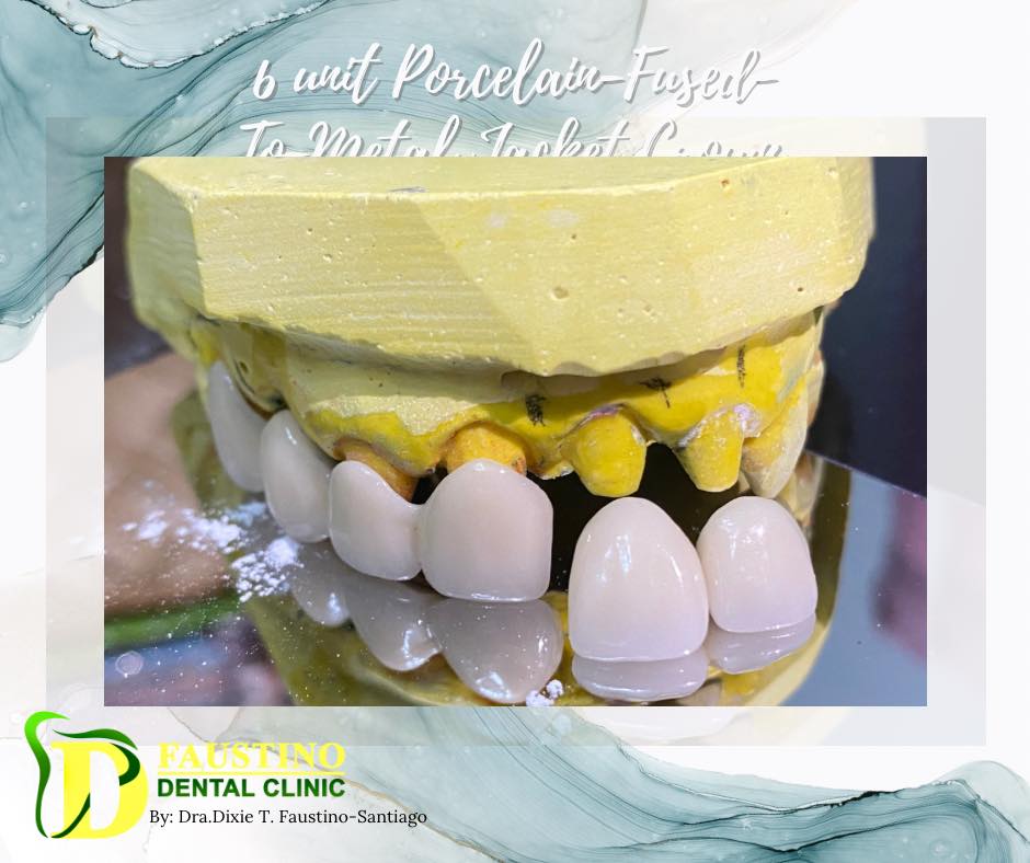 6unit PFM after Gingivectomy