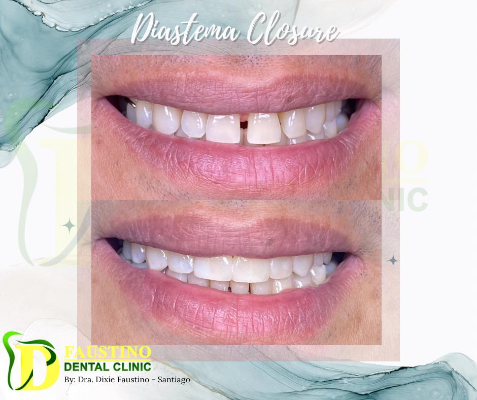 Diastema Closure