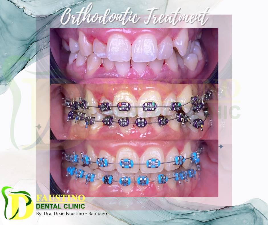 Orthodontic Treatment